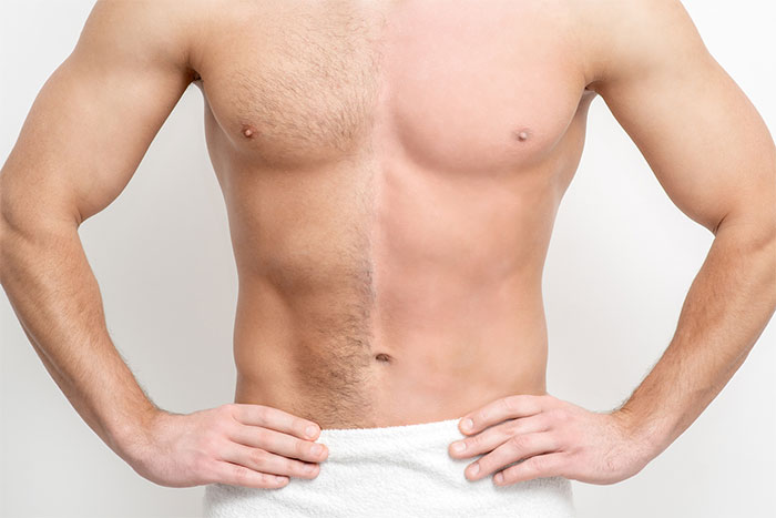 Permanent hair removal for men